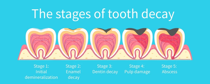 Stages of tooth decay